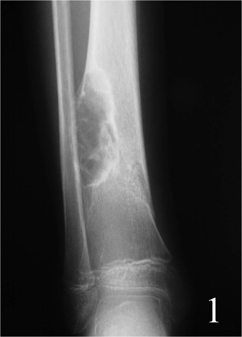 Ossifying Fibroma Tibia